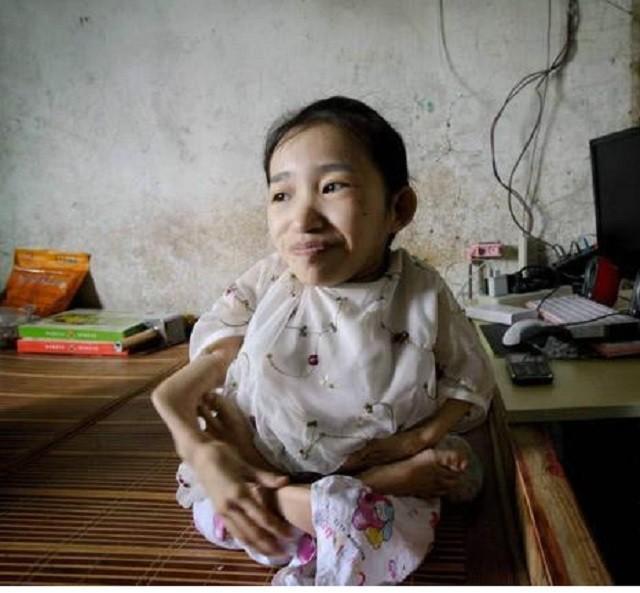 重庆“盆栽娃娃”：身高80厘米，平均每月骨折一次，睡觉不敢翻身