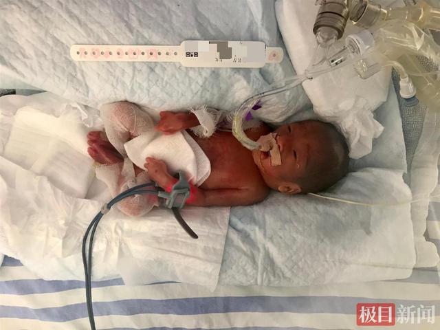 娘胎里只待了24周，体重500克的龙凤胎宝宝着急出生，专家守护100多天助娃挺过生死关