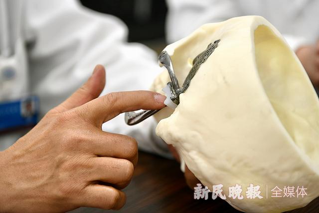 30年攻关，上海医生解决颞下颌关节“世界难题”